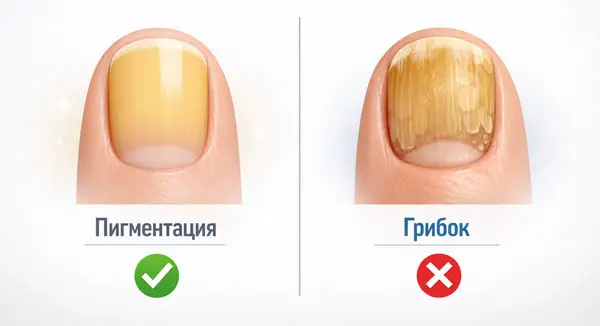 Порівняння пігментації та грибка на пожовтілому нігті